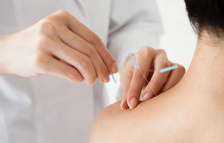 Điện mẵng châm điều trị liệt chi trên